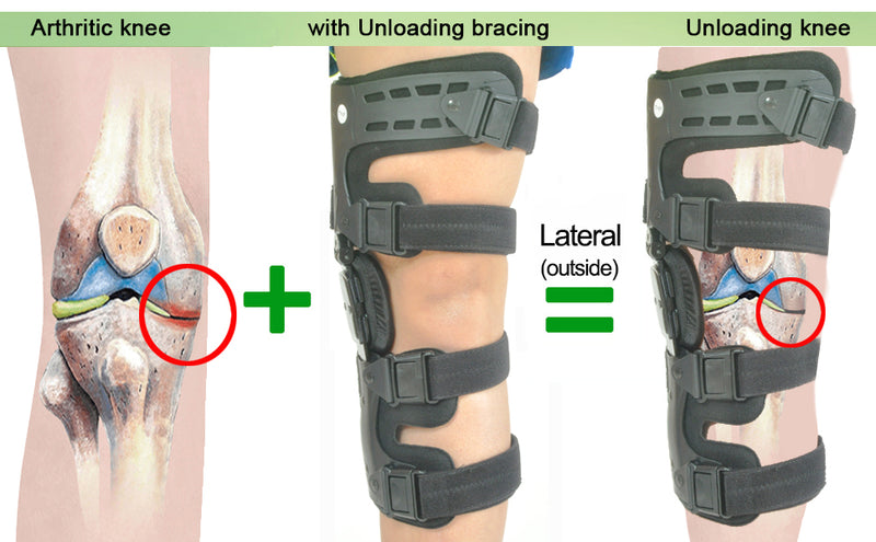 Braces for Knee Osteoarthritis / OA Knee Pain