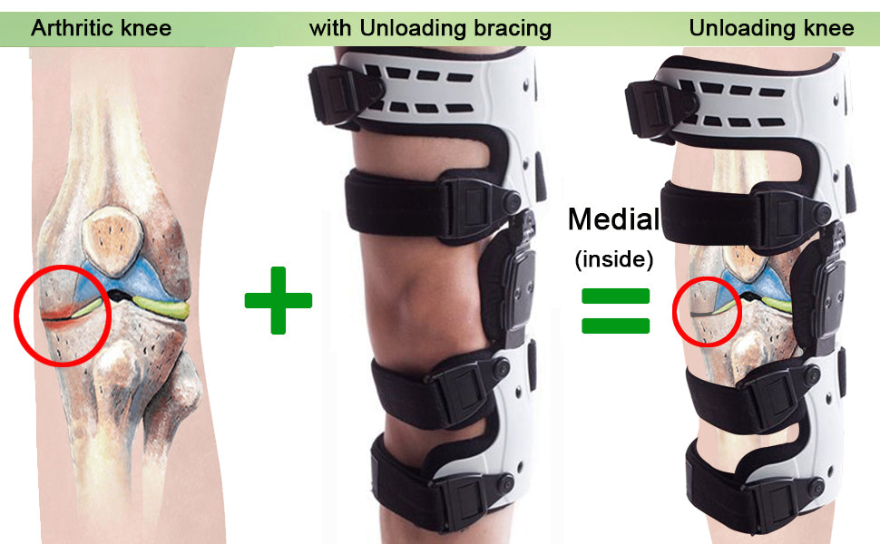 Orthomen OA Unloader Knee Brace - Support for Arthritis Pain Osteoarthritis  Cartilage Defect Repair Avascular Necrosis Bone on Bone Knee Joint Pain and  Degeneration (Medial/Inside - Right) Right Right(Medial)